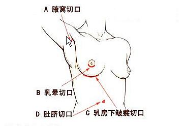 四种假体隆胸切口选择
