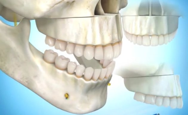 3D模型演示笑龈的正颚手术