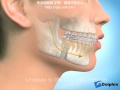 下颚后缩的正颚手术的治疗方式