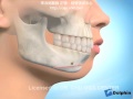 3D模型下巴后缩的削骨手术