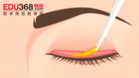 韩国流行的三种双眼皮手术方法