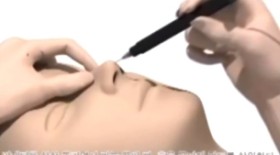 解析微创4D隆鼻技术
