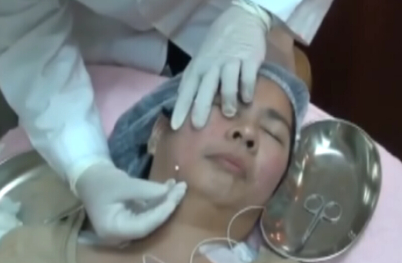 针灸埋线治疗改善肌肤老化脸皮下垂
