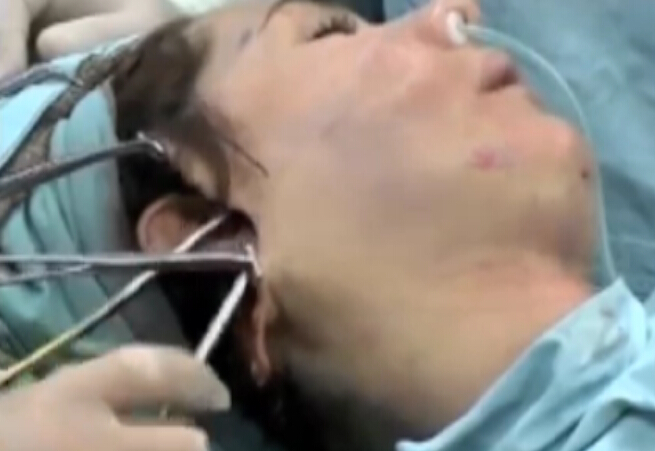 整形外科面部提升手术过程