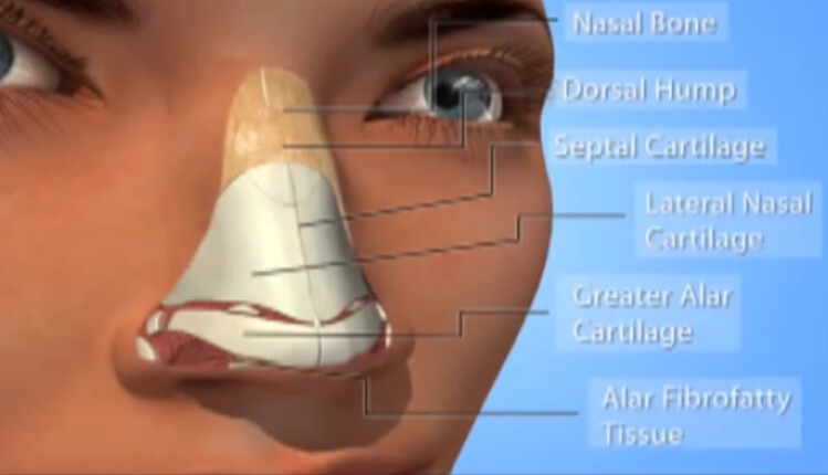 鼻整形术 驼峰鼻整形