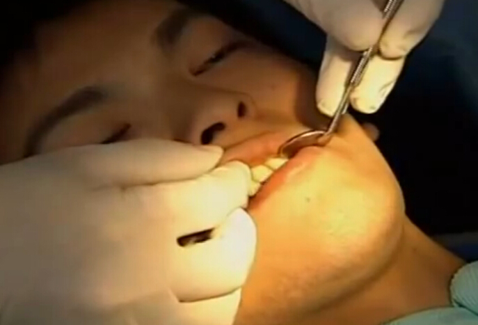 牙周病正确治疗方法