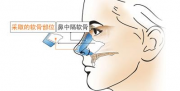 采用鼻中隔软骨垫鼻尖的护理对策