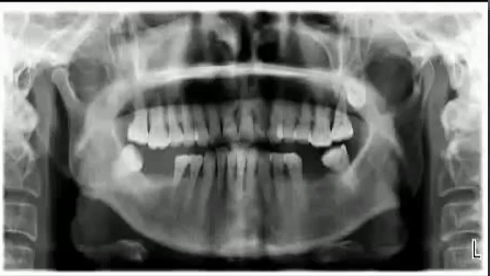 口腔健康牙齿手术和烤瓷冠修复过程