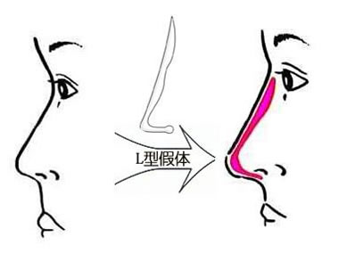 假体隆鼻最严重的并发症是什么