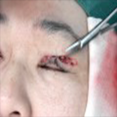 整形外科：双眼皮手术