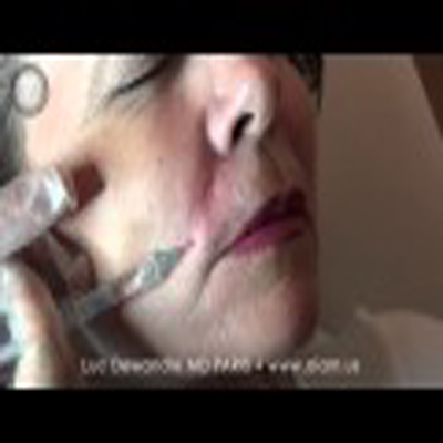 无痛医学美容：鼻唇沟的治疗过程
