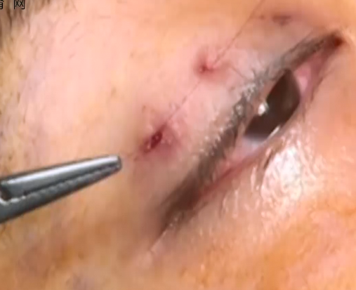 外科双眼皮埋线手术