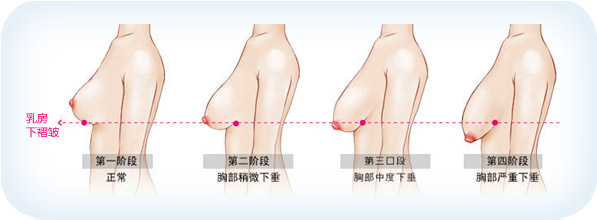 乳房下垂整形术有哪些